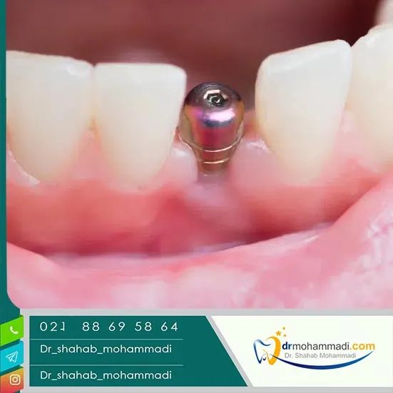 خطرات و راهکارهای کاهش ریسک ایمپلنت